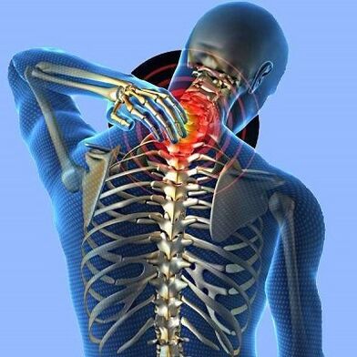 Bolest krku s cervikální osteochondózou