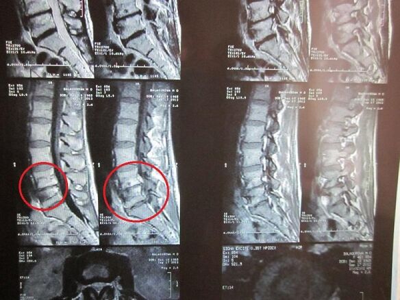 Diagnóza osteochondózy děložního čípku