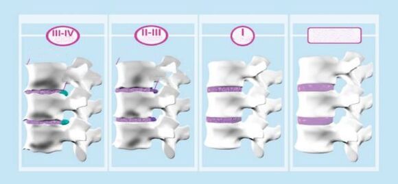 Fáze osteochondózy děložního čípku