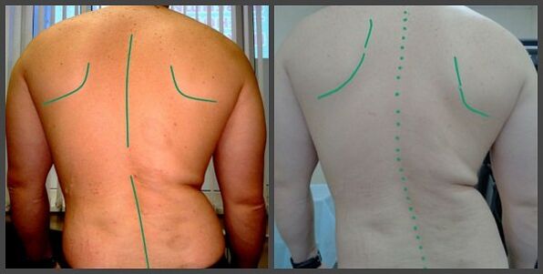 zakřivení páteře s osteochondrosou