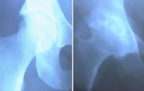 Spodina artrózy kolenního kloubu