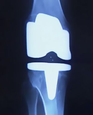 X -ray obrázek kolena s umělou protézou po operaci ke změně kloubu
