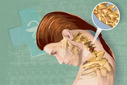 Reflexní příznaky osteochondrosy